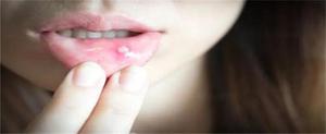 口腔溃疡疼痛难忍怎么快速缓解？